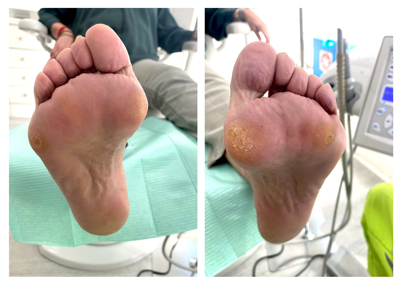 Callos en los pies, qué son, cómo tratarlos y prevenirlos