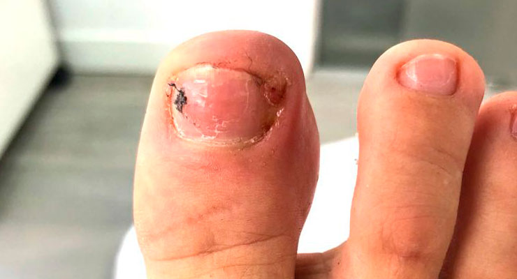 6 posibles causas de uña negra en el dedo gordo del pie  ClikiSaludnet   Fundación Carlos Slim
